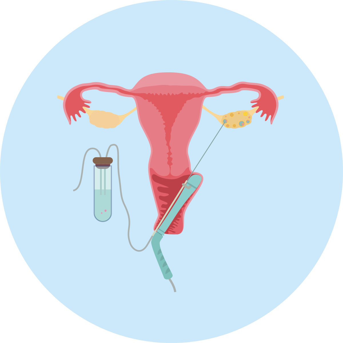 IVF process Egg Collection