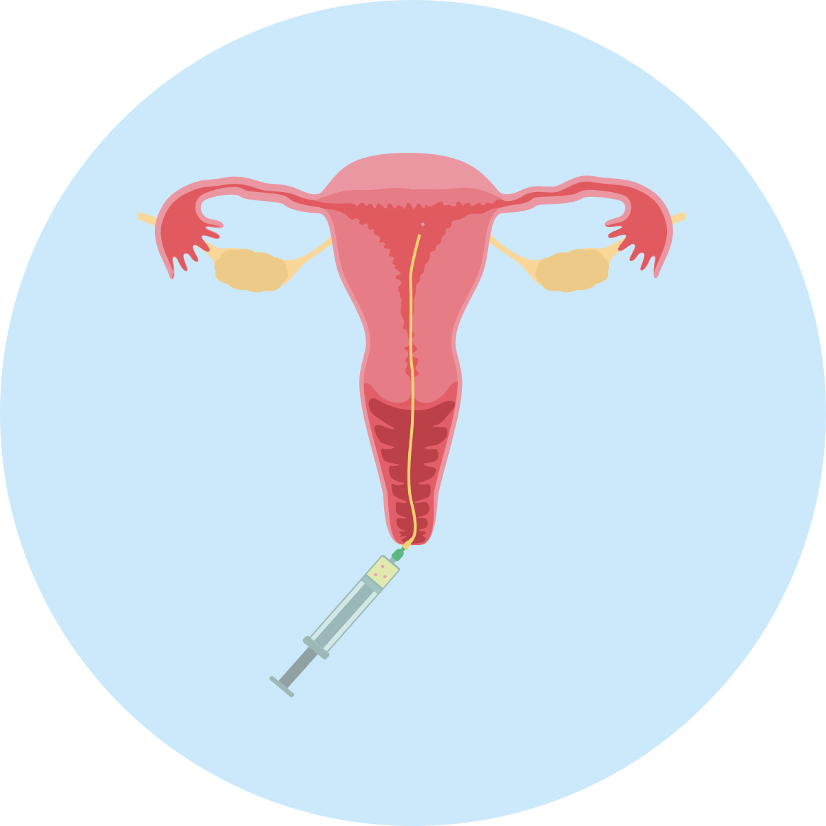 IVF process Embryo transfer